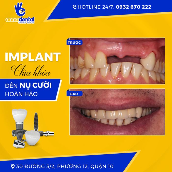 Hình ảnh 2 của Nha Khoa Anna - Trung Tâm Cấy Ghép Implant