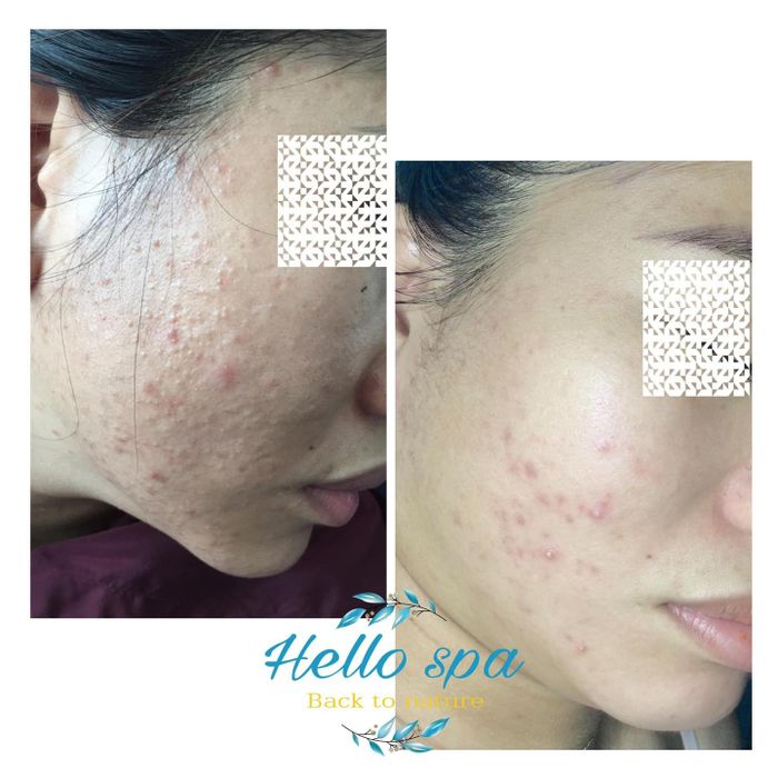 Ảnh 1 của Hello Spa Biên Hòa