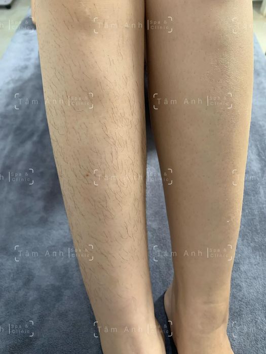 Ảnh 2 tại Tâm Anh Spa & Clinic