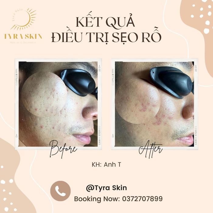 Ảnh Tyra Skin 2