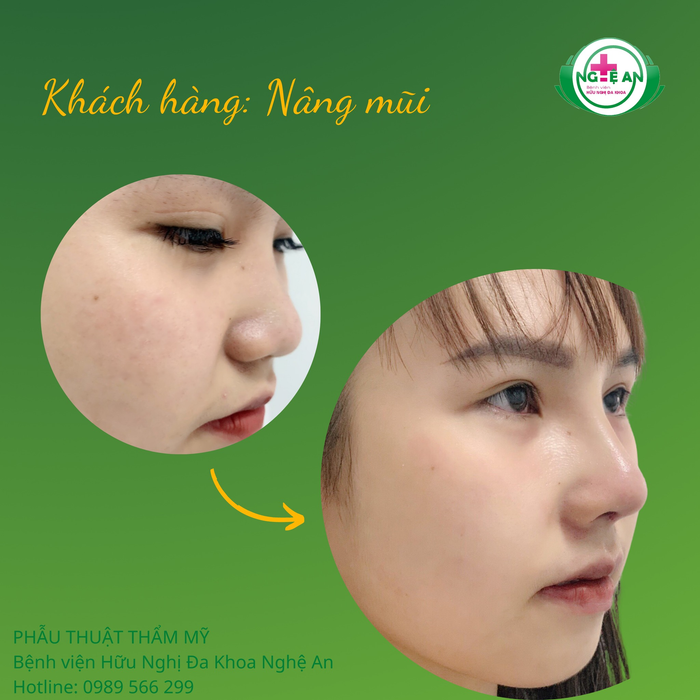 Hình ảnh Thẩm mỹ - Bệnh viện Hữu nghị Đa khoa Nghệ An 2