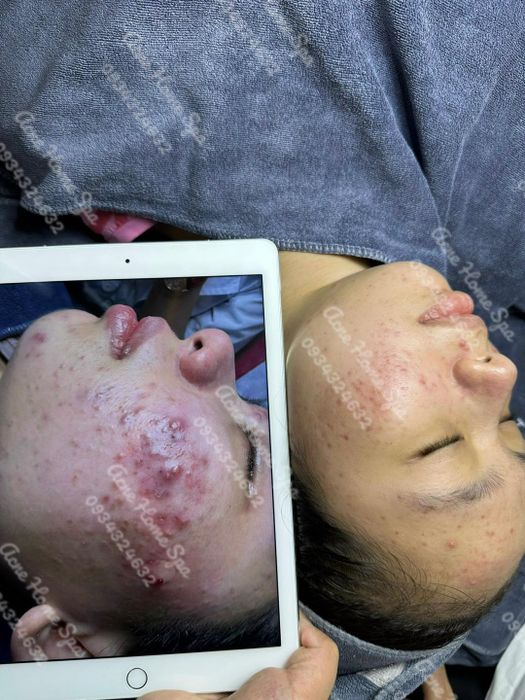 Hình ảnh 2 của Acne Home Spa