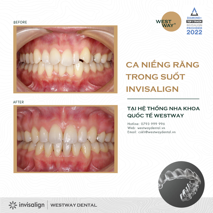 Westway - Niềng Răng Đẳng Cấp 5 Sao hình ảnh 2