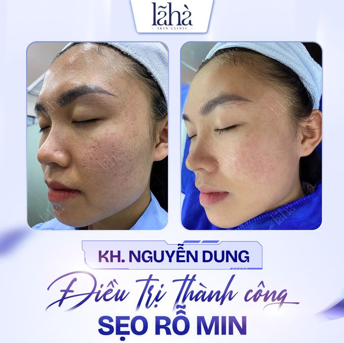 Hình minh họa (Nguồn: Lã Hà Clinic) ảnh 1