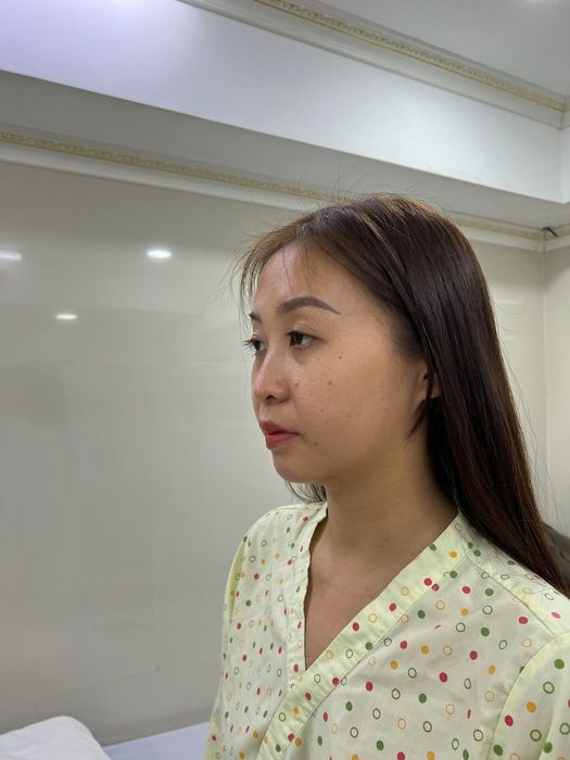 Trước khi nâng mũi ảnh 1