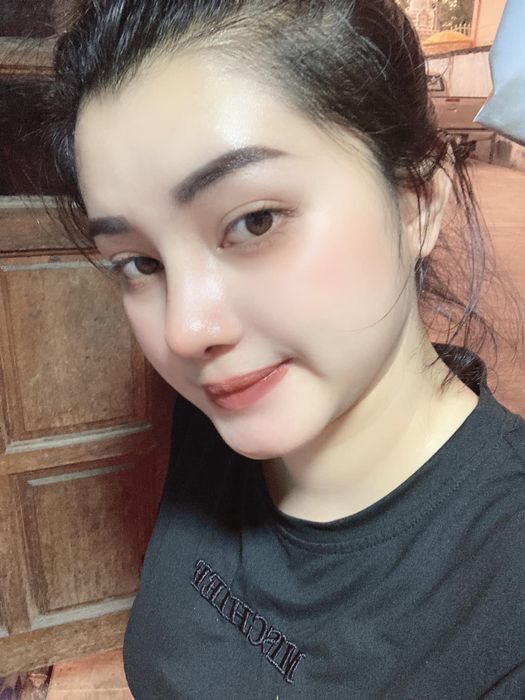 Mới nâng mũi xong, tránh khoe ngay và đừng quá chú ý đến nhận xét khi mũi còn sưng và bầm tím ảnh 2