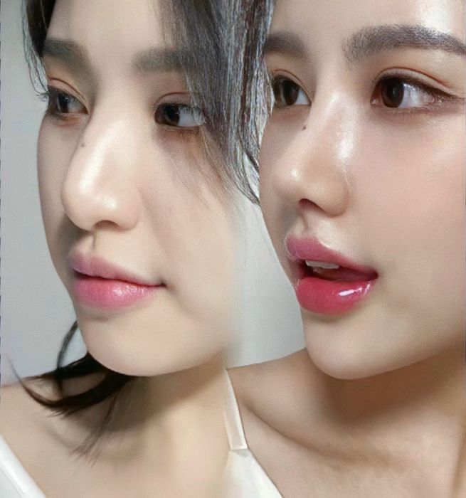 Sửa mũi 3 lần mới hài lòng, trải nghiệm như thế nào? ảnh 1