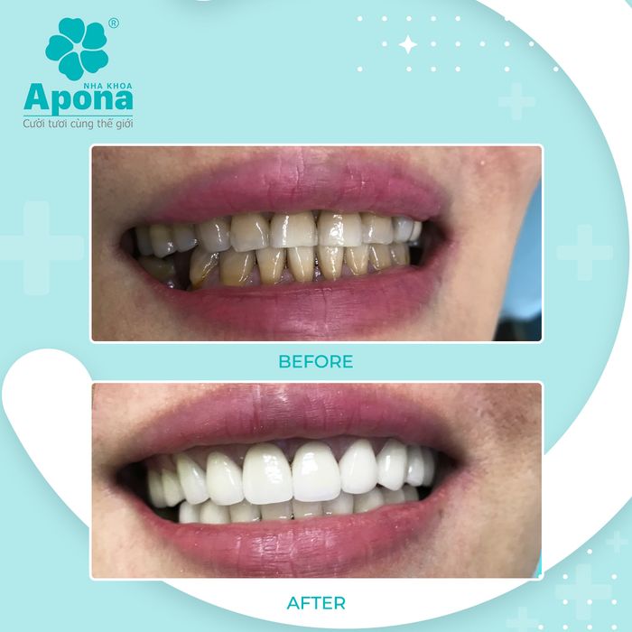 Hình ảnh 2 của Nha khoa Apona - Chuyên về răng toàn sứ thẩm mỹ & implant
