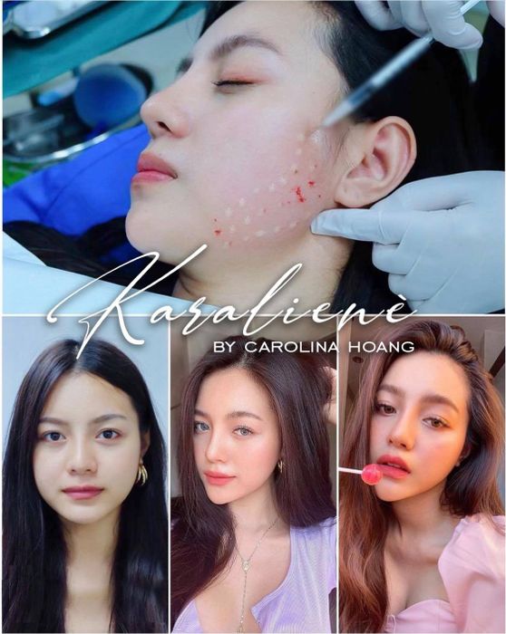 Hình ảnh 1 của Karalienè - Thẩm Mỹ Filler Nha Trang