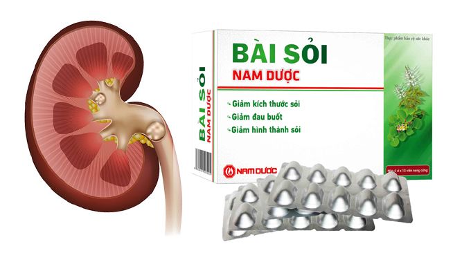 Hình ảnh Bài sỏi Nam Dược 1