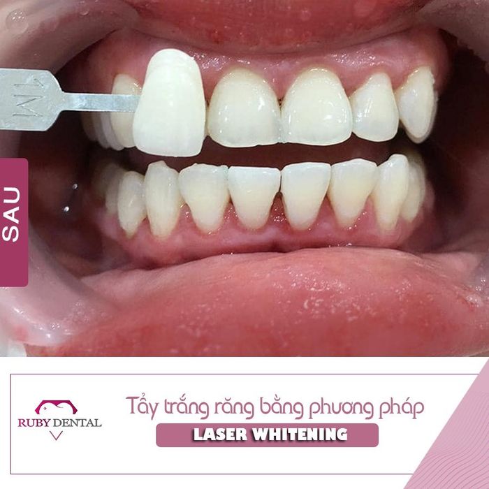 Hình ảnh niềng răng thẩm mỹ tại Ruby Dental 1