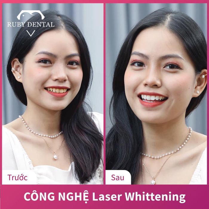 Hình ảnh niềng răng thẩm mỹ tại Ruby Dental 2