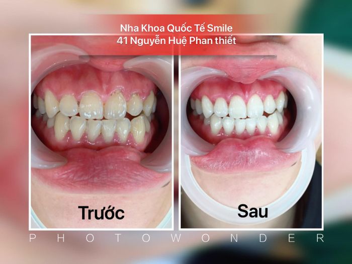 Hình ảnh 1 tại NHA KHOA QUỐC TẾ SMILE