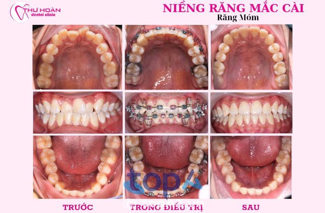 dịch vụ niềng răng đẹp tại Quy Nhơn