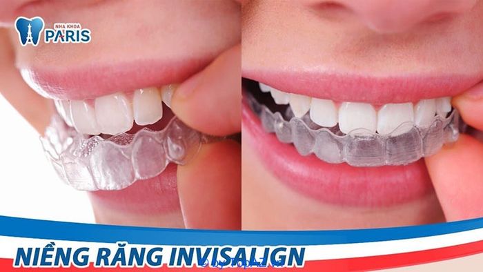 Địa chỉ niềng răng trong suốt chất lượng hàng đầu tại Hà Nội