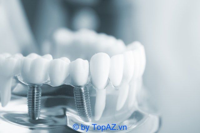 Địa chỉ cấy ghép răng implant tại Cần Thơ