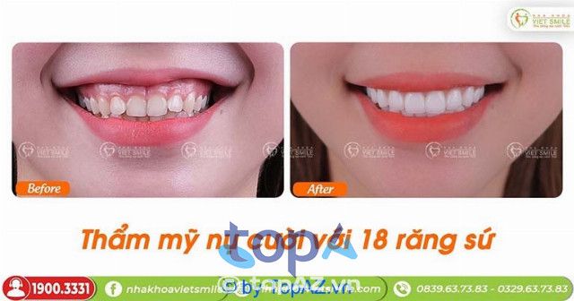 địa chỉ uy tín cho bọc răng sứ tại Hà Nội