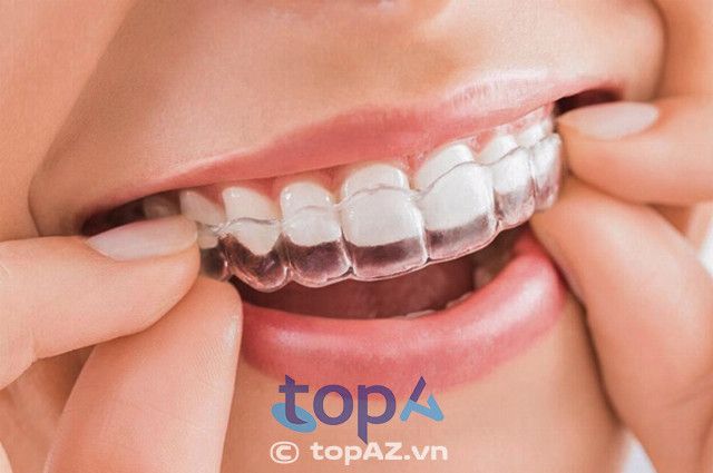 Địa chỉ niềng răng trong suốt tốt nhất ở TPHCM là đâu?