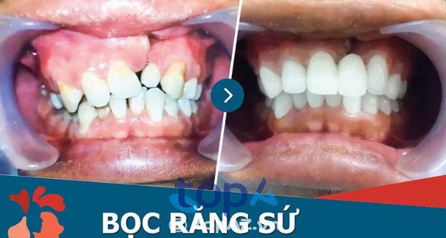 Bọc răng sứ giá hợp lý tại Hà Nội