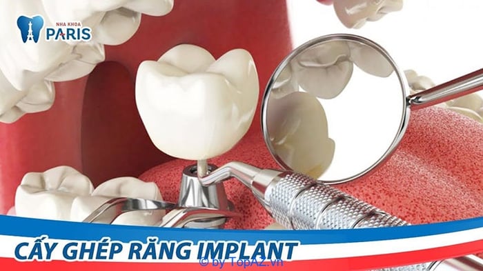 Nơi trồng răng implant uy tín tại TPHCM webtretho