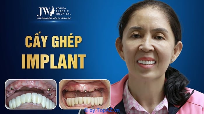 Trồng răng implant ở đâu tốt tại TP.HCM, Webtretho