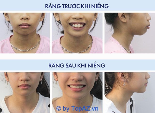 niềng răng cho trẻ em tại TPHCM