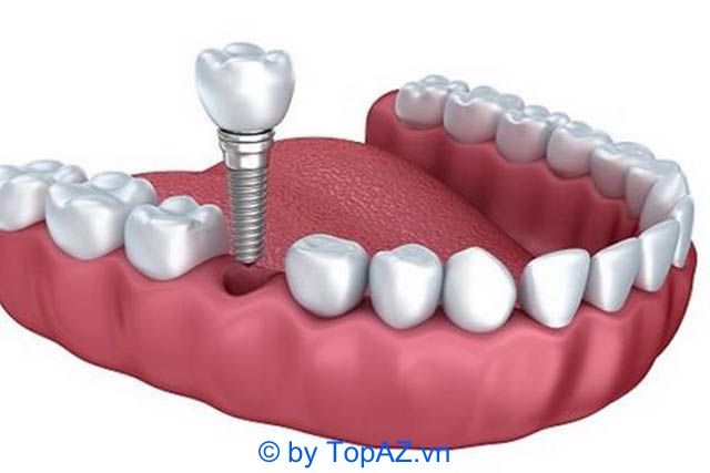 Địa chỉ trồng răng implant uy tín tại TP. Vinh, Nghệ An