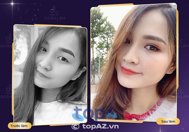 Chi phí cho phẫu thuật sửa mí mắt hỏng tại Hà Nội là bao nhiêu?