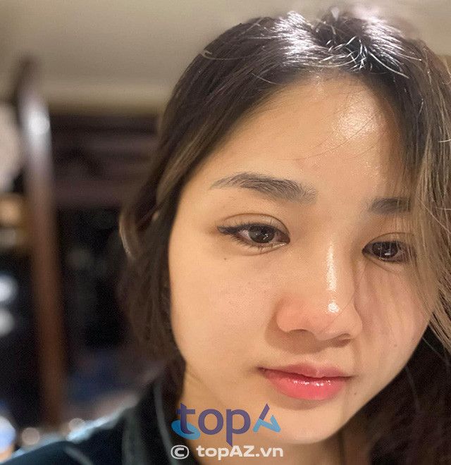 phẫu thuật sửa mí mắt hỏng tại Hà Nội có giá bao nhiêu?