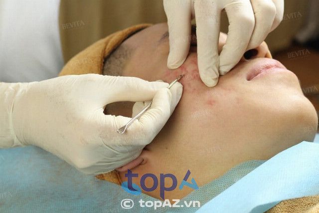 spa trị mụn tại Phú Thọ