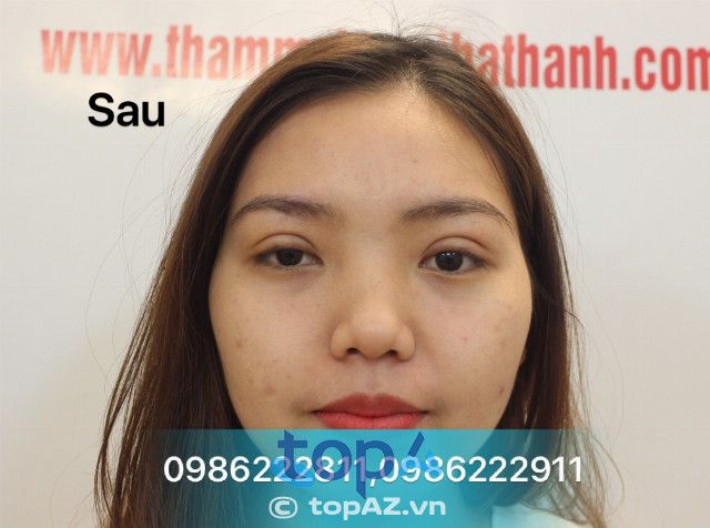 sửa mí mắt hỏng tại Hà Nội ở đâu đẹp?