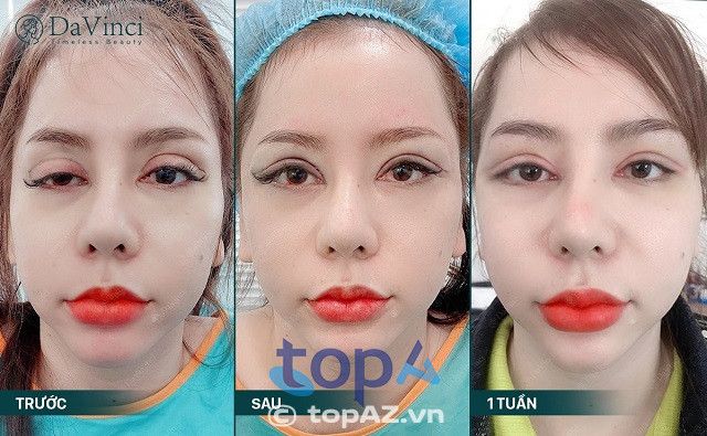địa chỉ sửa mí mắt hỏng tại Hà Nội gần đây