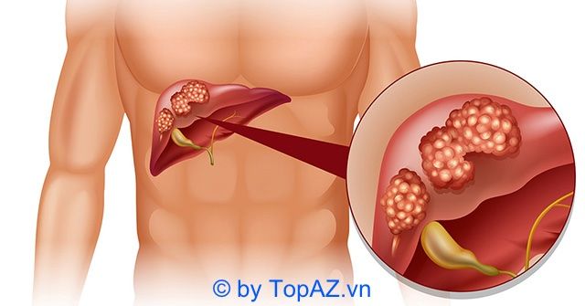 Cơ sở khám và điều trị viêm gan tại TPHCM