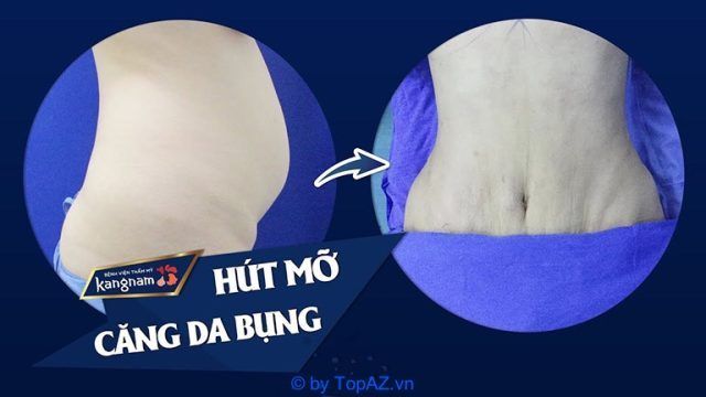 địa chỉ dịch vụ căng da bụng tại Hà Nội