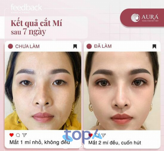 địa chỉ cắt mí mắt tại TP. Mỹ Tho