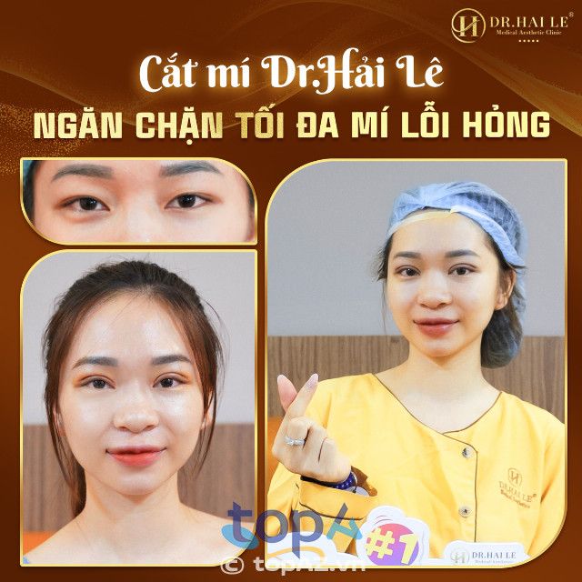 cắt mí mắt tại Hà Nội