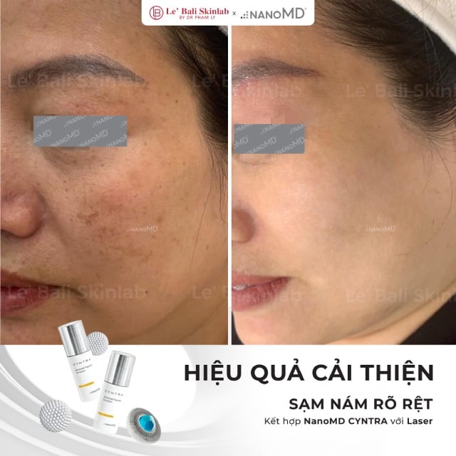 kết quả điều trị nám tại Le’ Bali SkinLab Hà Nội