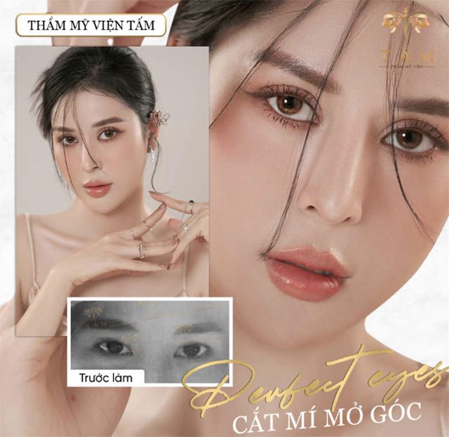 Cắt mí và mở góc mắt đẹp tại TP.HCM, thẩm mỹ viện Tấm, quận 7