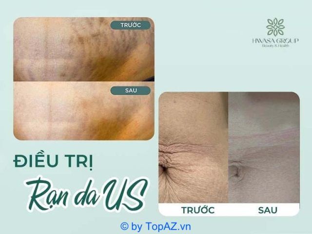 điều trị rạn da tại TPHCM