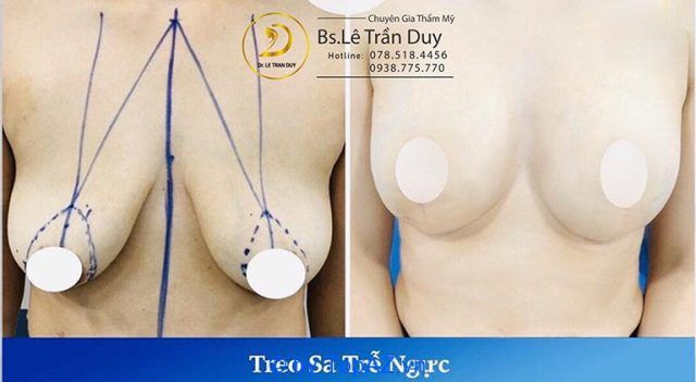 treo ngực sa trễ tại TP.HCM