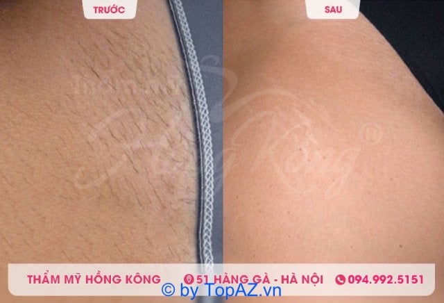 Thẩm mỹ Hồng Kông là địa chỉ nổi tiếng về triệt lông tại Hà Nội