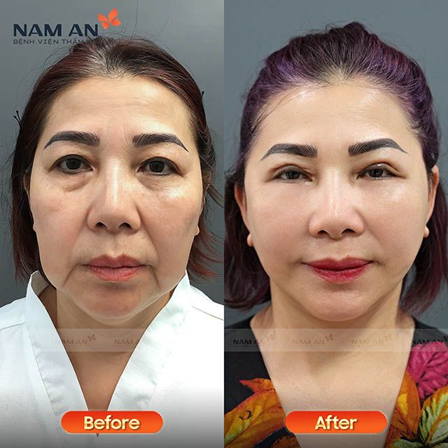 Bệnh viện Thẩm mỹ Nam An cung cấp dịch vụ căng da bằng chỉ Collagen với hiệu quả cao, duy trì từ 1 đến 3 năm.