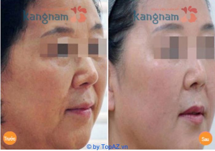 địa chỉ hàng đầu cho căng da bằng chỉ Collagen tại TPHCM