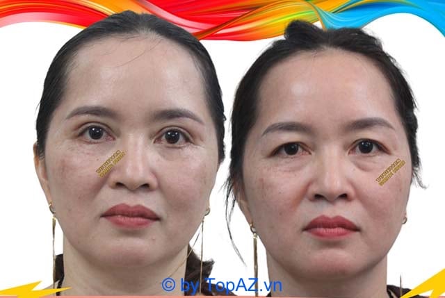 tiêm filler tại nha trang