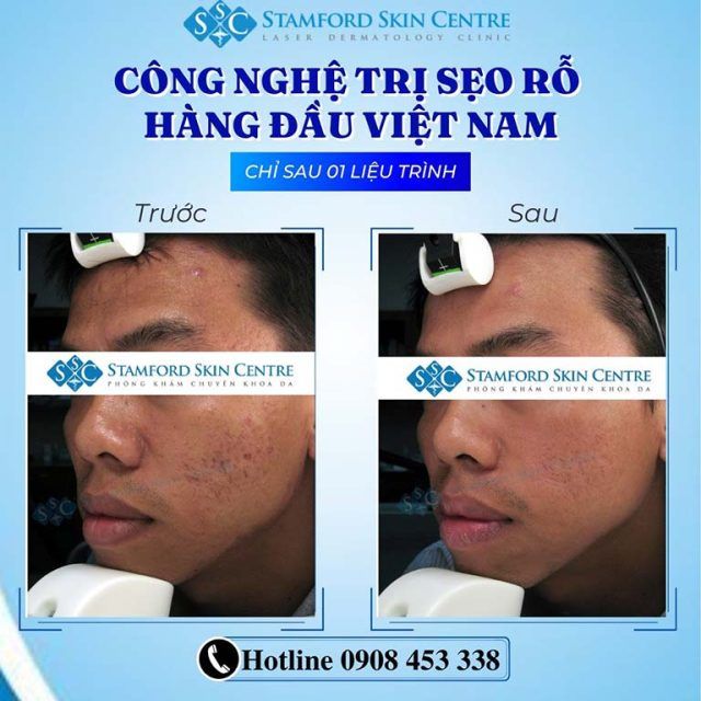 thẩm mỹ viện điều trị sẹo tại TPHCM