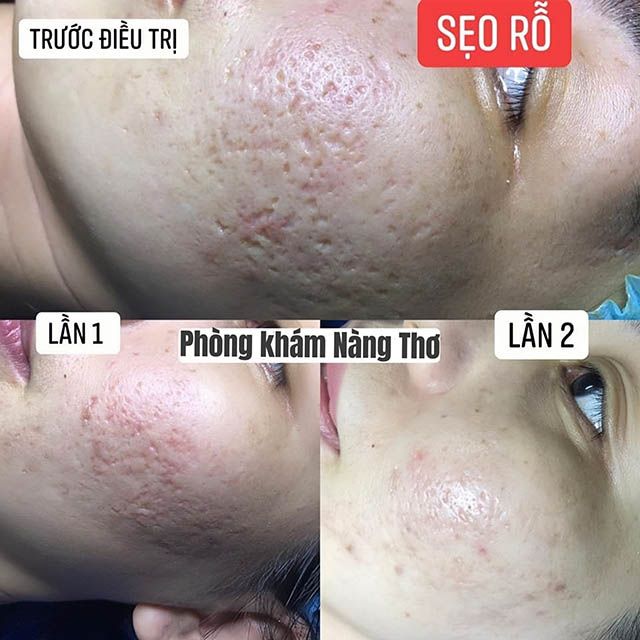 trị sẹo rỗ chất lượng tại TPHCM