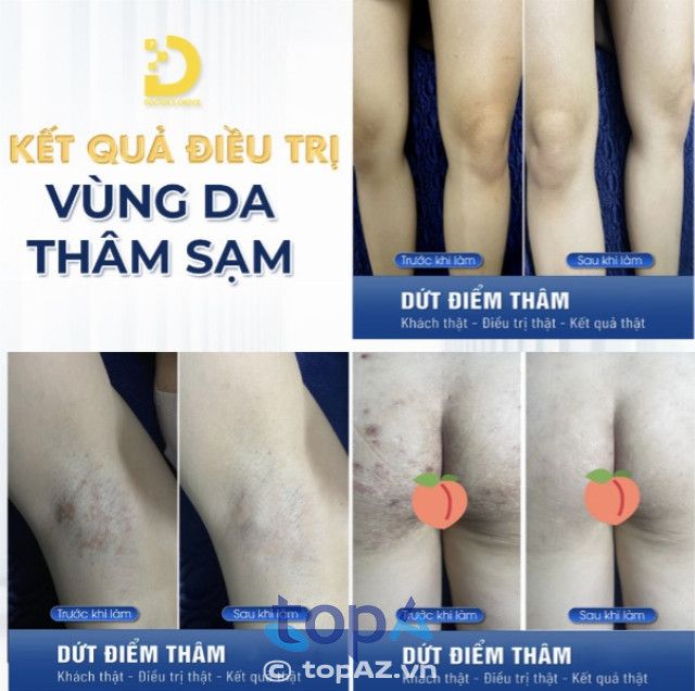 Trị thâm mông tại TP.HCM – Dr.Choice Clinic