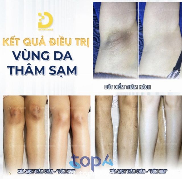 Trị thâm nách, mông và bẹn tại TP.HCM – Dr.Choice Clinic