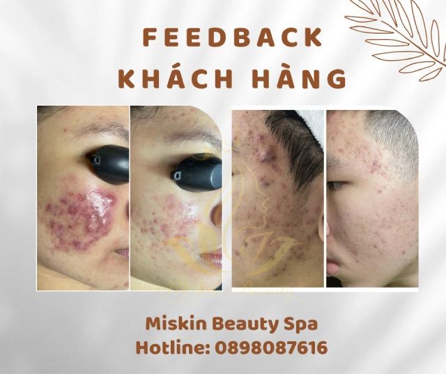 Miskin Beauty Spa (địa chỉ uy tín để nặn mụn và lấy nhân mụn tại TP.HCM)