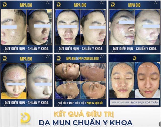 Nặn mụn uy tín tại TPHCM – Doctor’s Choice